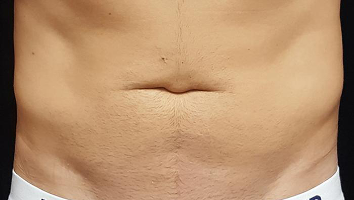 Non-Invasive Body Contouring - TruSculpt 3d - Columbia Skin Clinic