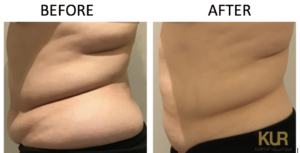 Anti-cellulite TruSculpt® 3D - KUR Skin Lab